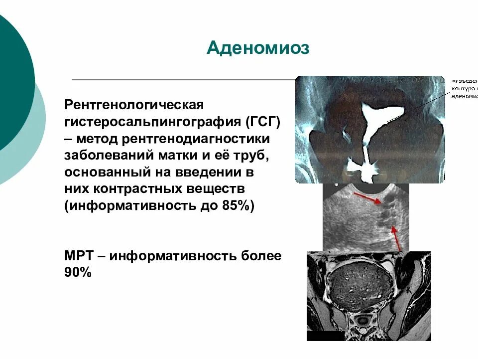 Гистеросальпингография эндометриоз. Гистеросальпингография аденомиоз. Гистеросальпингография (ГСГ).