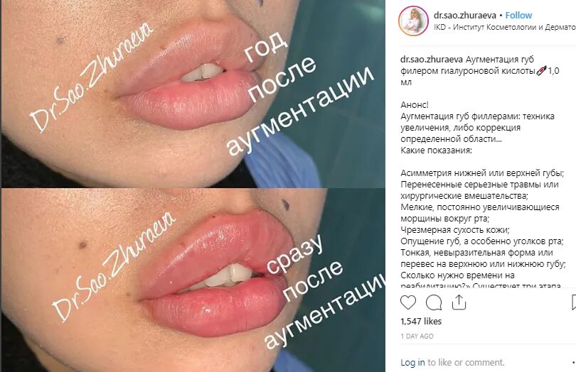 Что нельзя делать перед процедурой увеличения губ. Методика введения филлера в губы. техника введения филлера в губы. техники контурной пластики губ. техника увеличения губ филлерами.