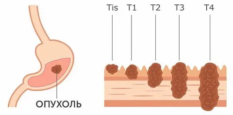 Рак 4 стали