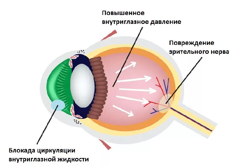 Строение глаза при глаукоме. Патогенез глаукомы.