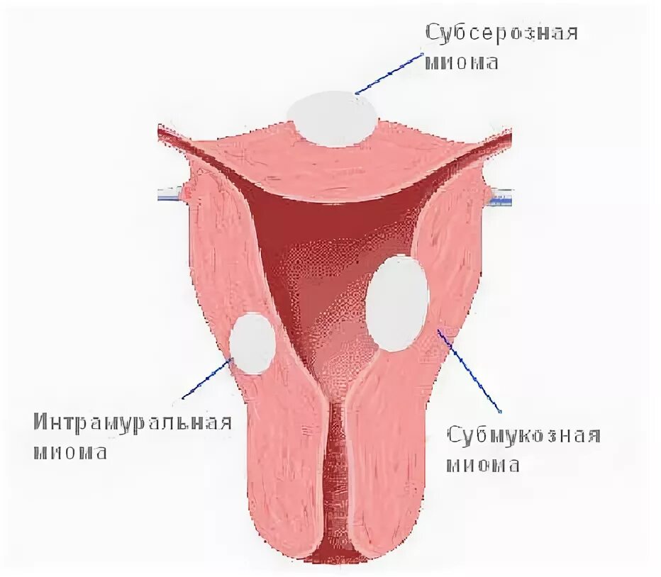 Лейомиома матки что это. Миома матки интрамуральный узел. Инромуальный субсерезный миома. Интрамурально субсерозная миома матки субмукозная. Интрамуральный субмукозный узел.