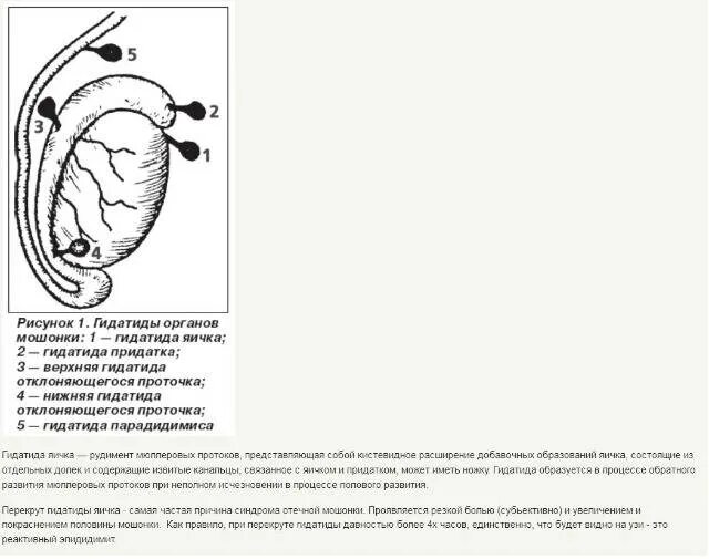 Болит правое яйцо у мужчин причина. Перекрут придатка гидатида яичка. Острое поражение гидатиды яичка. Кальцинированная гидатида яичка. Перекрут гидатиды яичка гистология.