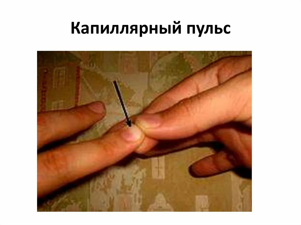 Капиллярный пульс. Капиллярный пульс квинке. капиллярный пульс квинке норма. симптом квинке капиллярный пульс.