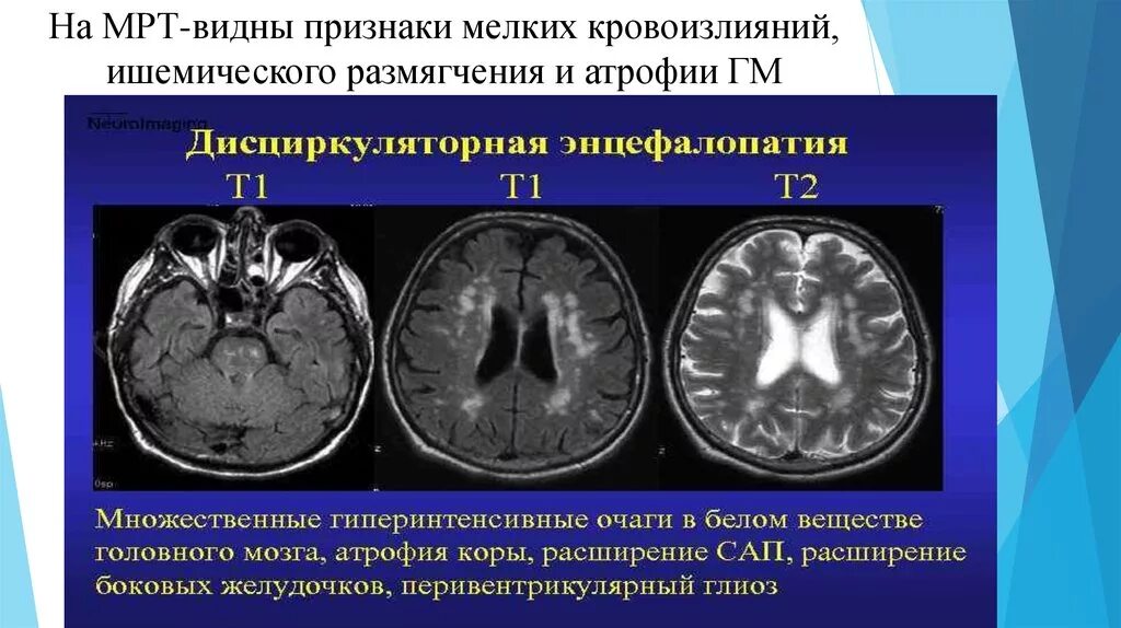 Атрофия головного мозга на кт. Атрофические изменения головного мозга кт. Атрофия коры головного мозга мрт.