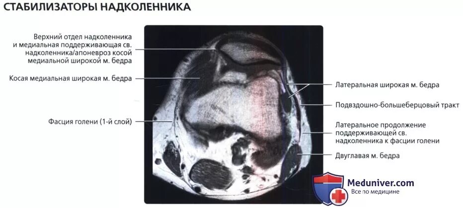 Латерализация надколенника. Хондромаляция надколенника хруст. Хондромаляция надколенника Outerbridge. Связки надколенника анатомия мрт. Повреждение ретинакулума надколенника.