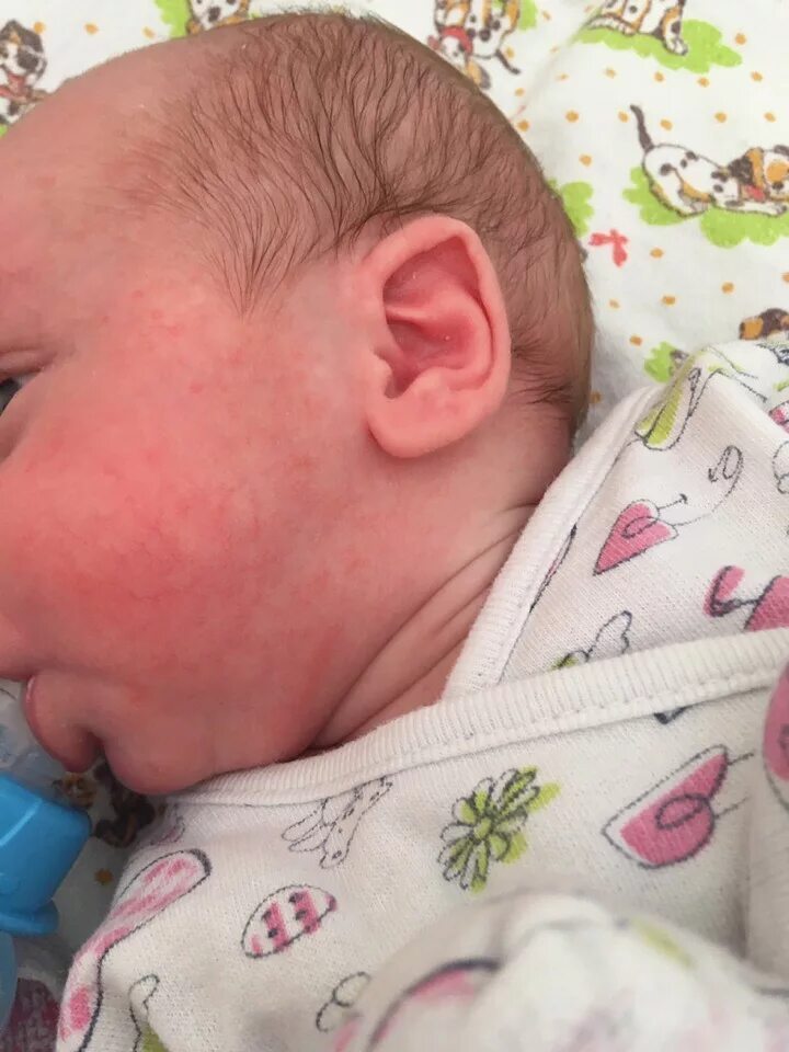 Аллергия на смесь у ребенек. Высыпания ребенка на смесь у грудничка. Аллергия у новорожденных на лице.
