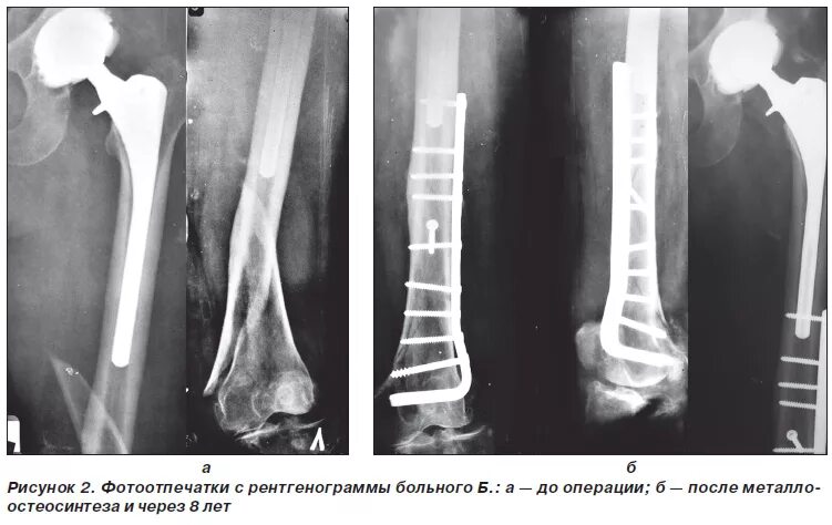 остеосинтез перелома бедренной кости. интрамедуллярный остеосинтез бедренной. остеосинтез перелома шейки бедра системой dhs. чрезвертельный перелом остеосинтез. интрамедуллярный остеосинтез бедра рентген.