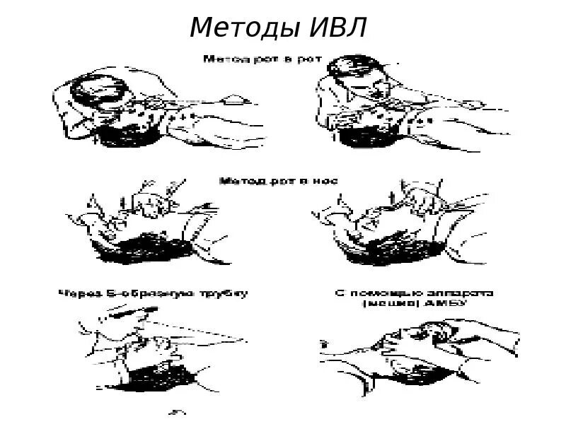 Искуственная вентиляция легких алгоритм кратко. Искусственная вентиляция легких (ИВЛ). Способы искусственной вентиляции.