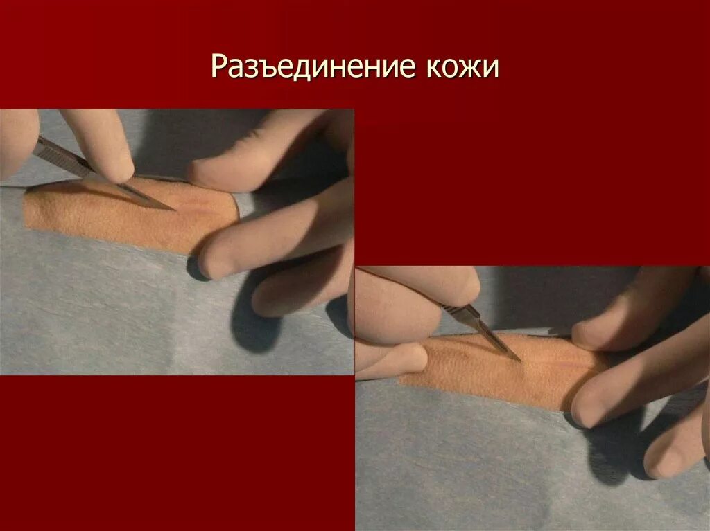 Методы разъединения тканей.