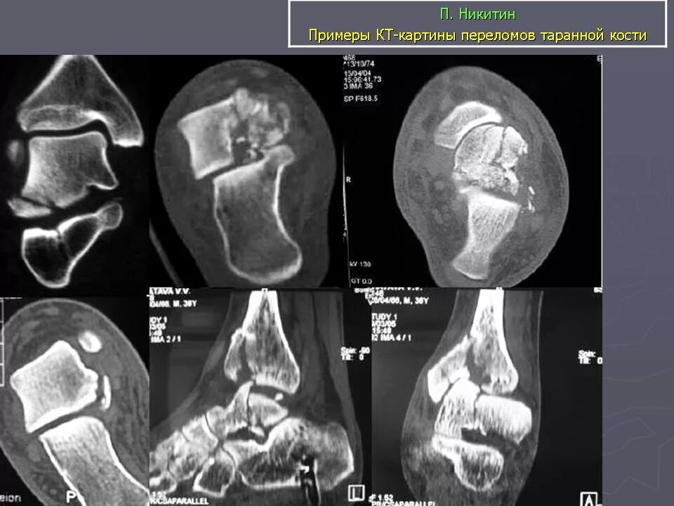 Перелом таранной кости на кт. Импрессионный перелом таранной кости. Остеомиелит таранной кости кт.