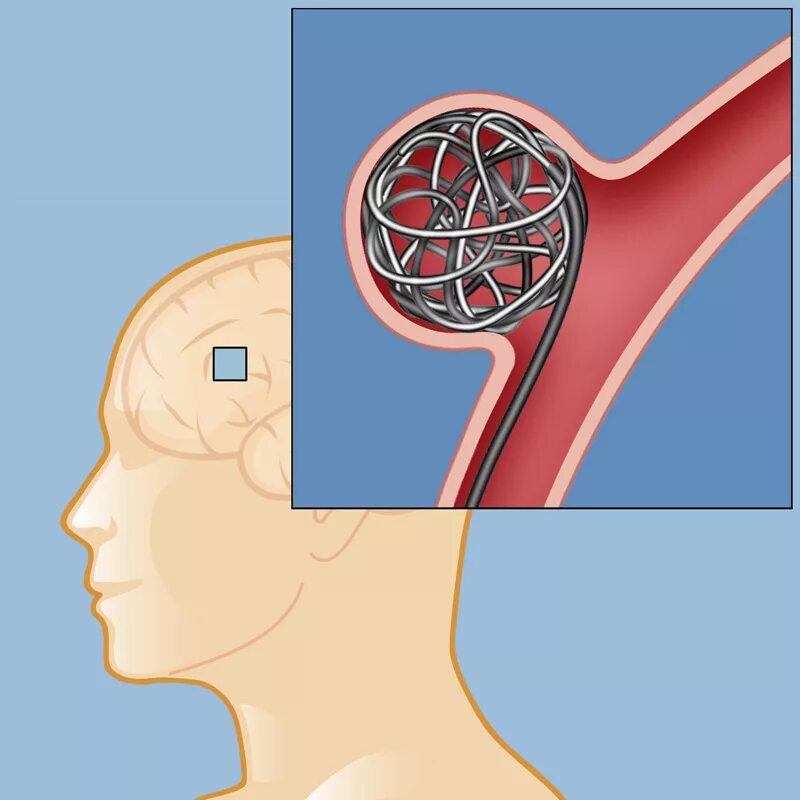 Аневризма головного мозга. Аневризм головного мозга. Микроаневризма сосудов головного. Внутричерепные аневризмы. Аневризма мозга простыми словами