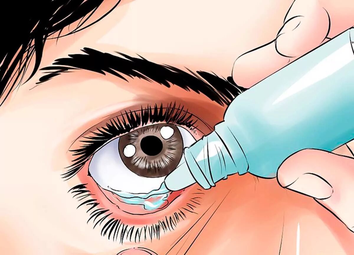 Помощь при инородном теле в глазу. Конъюнктивит мешок конъюнктивальный. Закапывание глазных капель в конъюнктивальный мешок. Нижний конъюнктивальный мешок глаза. Строение глаза человека конъюнктивальный мешок.