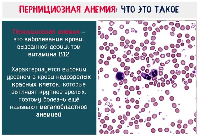 В12 в эритроцитах. В12-пернициозная анемия. в12-дефицитная (пернициозная) анемия;. мегалобластическая анемия аддисона бирмера. нейтрофилы при пернициозной анемии.