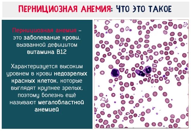 Малокровие недостаток витамина. В12-пернициозная анемия. В12 мегалобластная анемия. Картина крови при пернициозной анемии. В12 дефицитная анемия гипохромная.