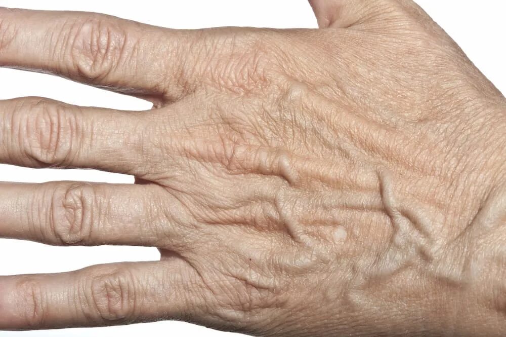 лазерная наноперфорация постакне. прозрачная тонкая кожа. омоложение рук до и после. почему кожа становится тонкой. сухой.