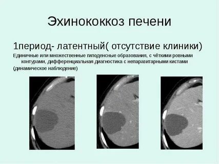 Диагностика эхинококкоза печени