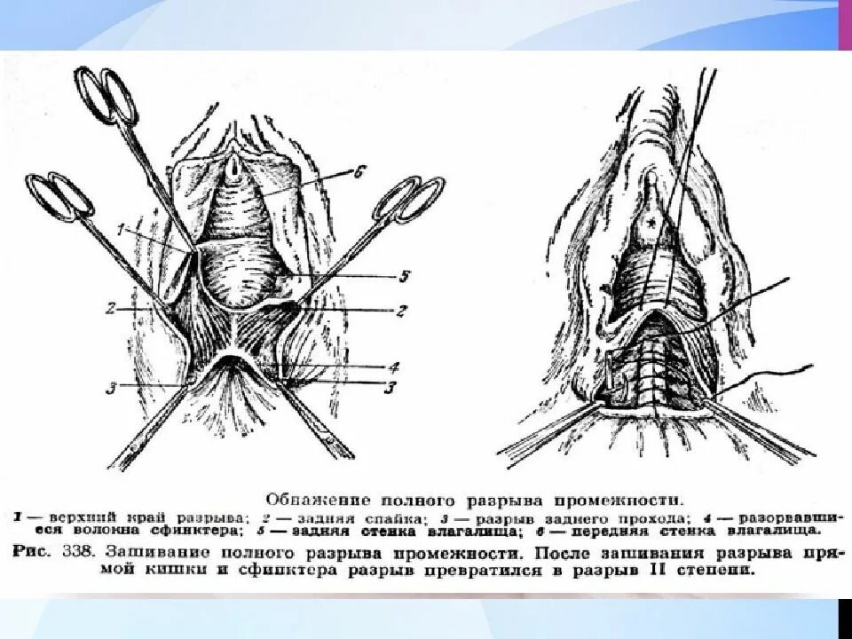 Ушивание разрыва промежности. Разрыв промежности 3 степени. Зашивание разрыва промежности 1 степени. Ушивание разрыва промежности 2 степени.