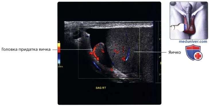Норма.УЗИ мошонки.яичек. УЗИ органов мошонки + допплерография. Артерии яичка