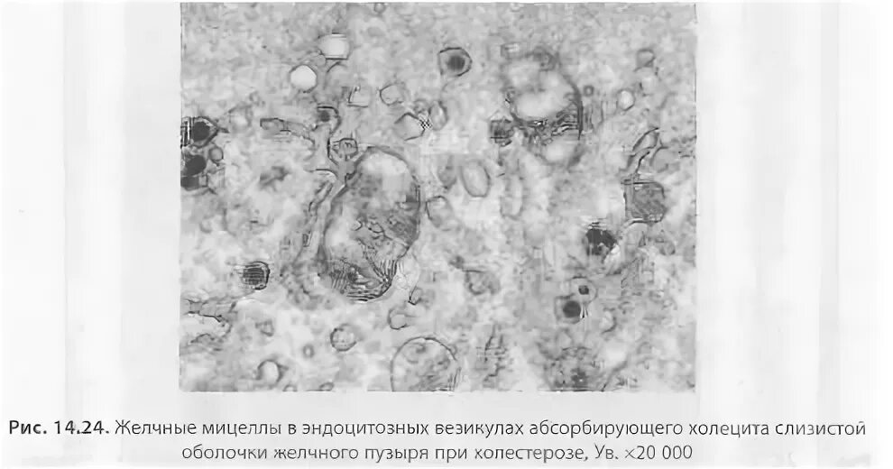 Слизистая оболочка желчного пузыря. Холестероз желчного пузыря гистология. Холестероз слизистой оболочки желчного пузыря. Холестероз желчного пузыря микропрепарат. Холестероз стенки желчного пузыря гистология.