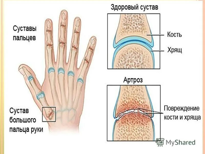 Суставы пальцев сильно. Деформирующий остеоартроз межфаланговых суставов кистей. Межфаланговые суставы (узелки Гебердена, Бушара);. Сустав указательного пальца.