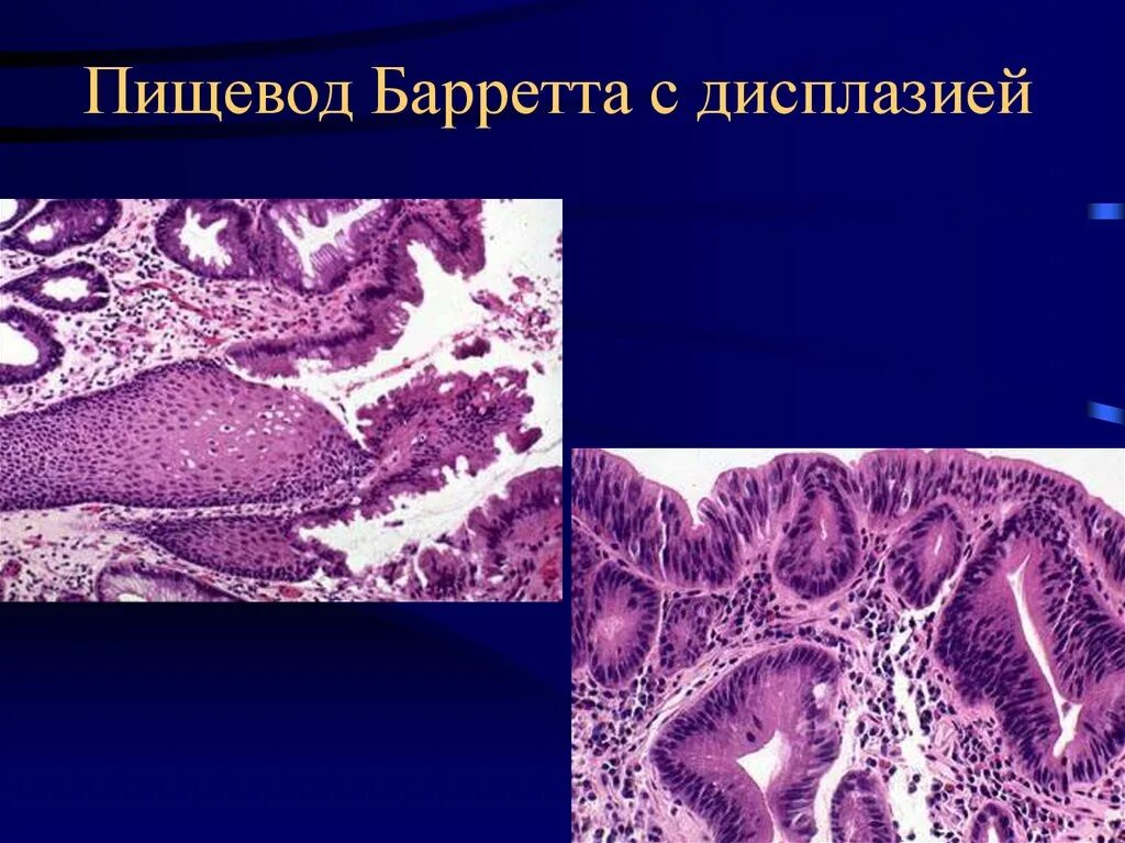 Пищевод Барретта патанатомия. Пищевод Барретта (с 1 m2).. Пищевод Барретта метаплазия эпителия.