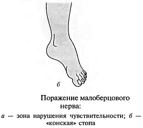 Парез стопы. Симптомы повреждения общего малоберцового нерва. Нейропатия большеберцового нерва. Поражение малоберцового нерва симптомы. Нейропатия малоберцового нерва.