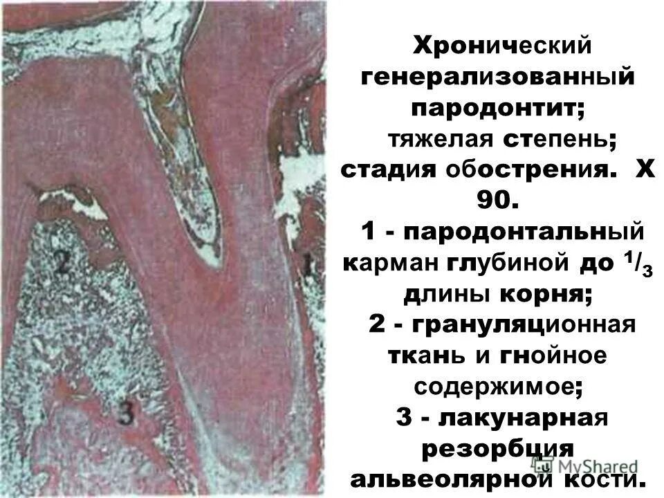 генерализованный пародонтоз.