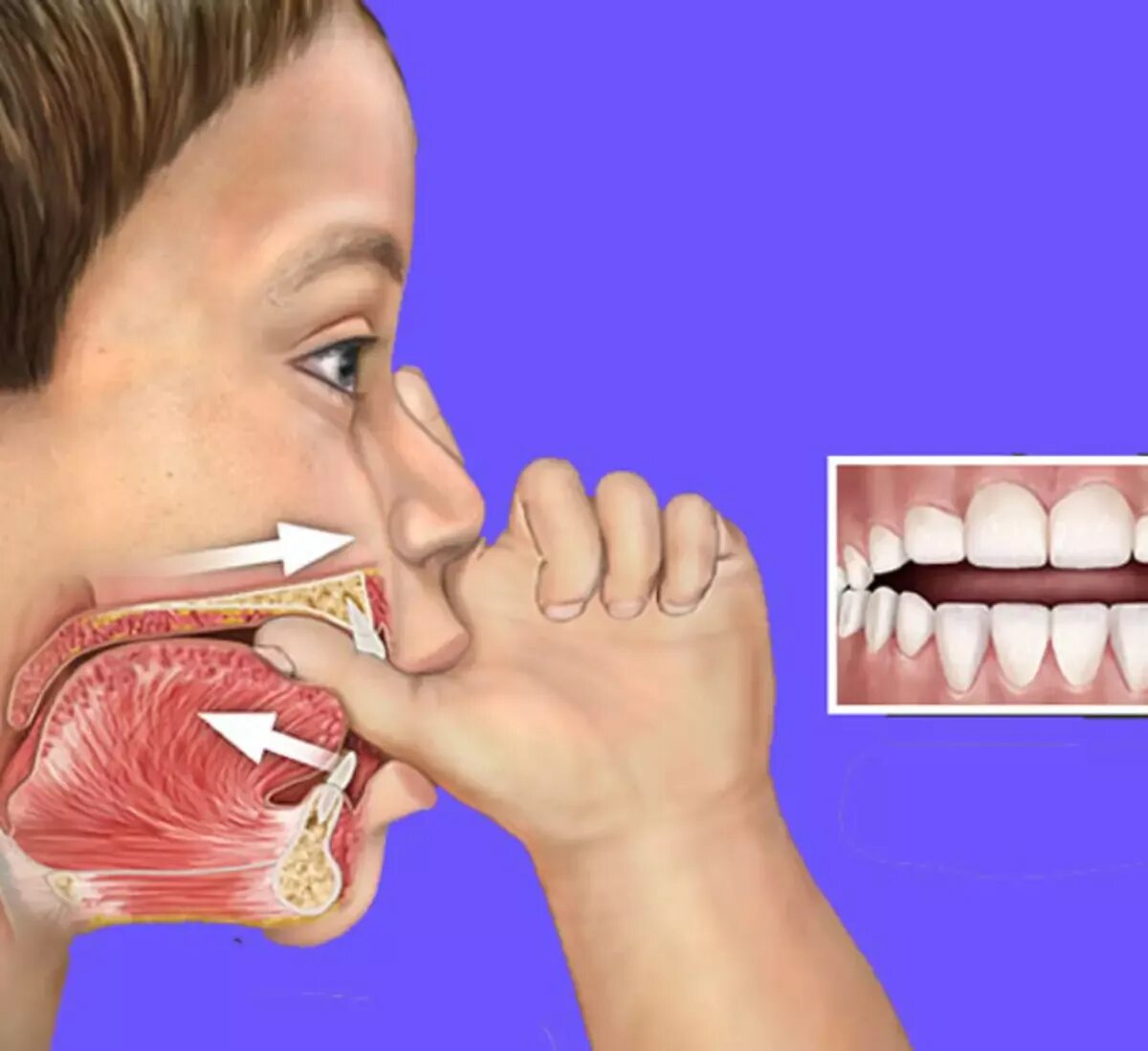 Ротовое дыхание челюсть. Смоктать