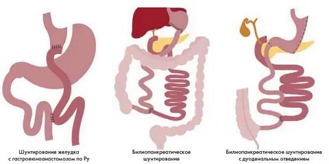 Бариатрическая операция диабет