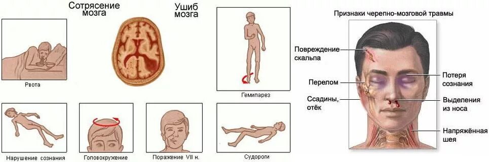 Сотрясение при ударе. ЧМТ средней степени симптомы. Признаками сотрясения или ушиба головного мозга являются. Клинические проявления ушиба головного мозга. Внешние признаки сотрясения мозга.