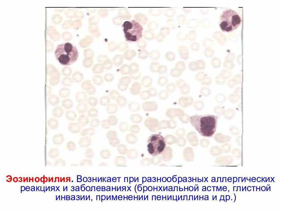 Эозинофилия периферической крови. Эозинофилия картина крови. Эозинофильный лейкоцитоз картина крови. Эозинофильный лейкоцитоз