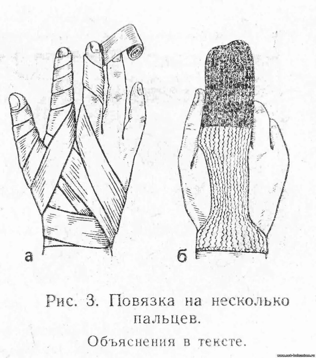 Наложение повязки на палец. Наложение спиральной повязки на палец руки. Повязка при повреждении пальца. Повязка при повреждении пальца. Повязка, применяемая при ранении пальцев кисти.