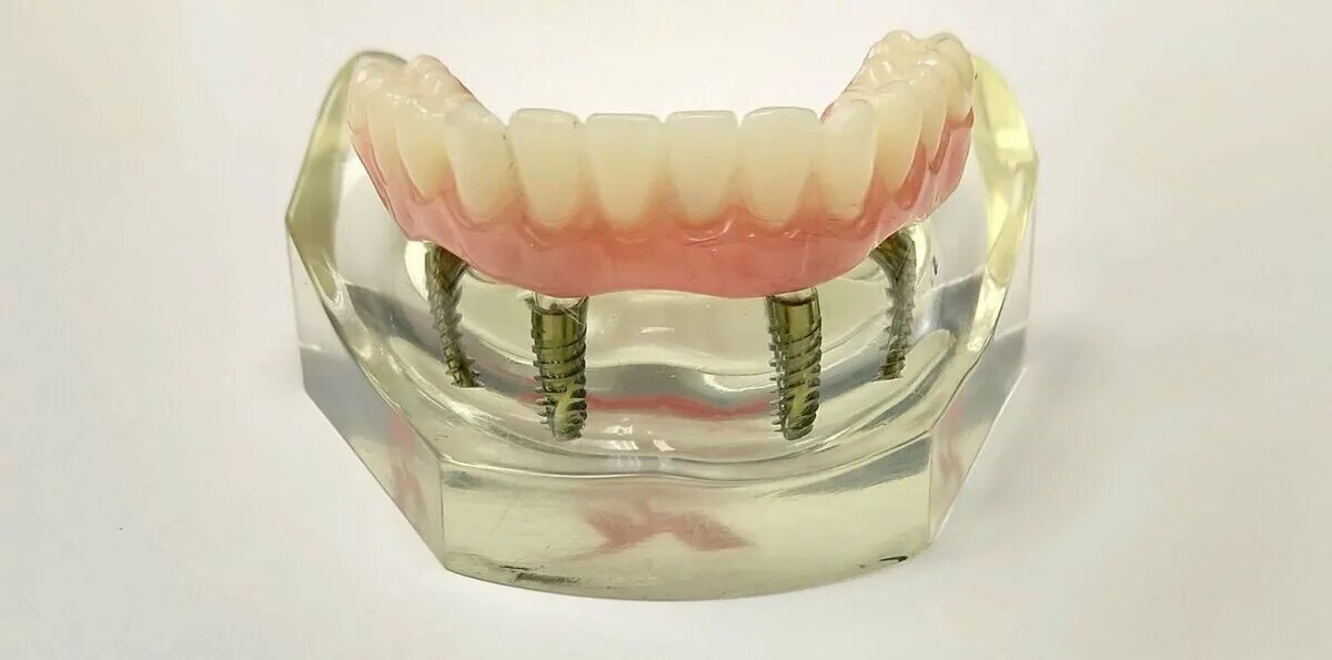 Несъемные зубные протезы на 4 имплантах. Несъёмный мостовидный протез челюсти. Протез нижней челюсти на 4 имплантах. Зубной протез верхней челюсти на 4 имплантах.