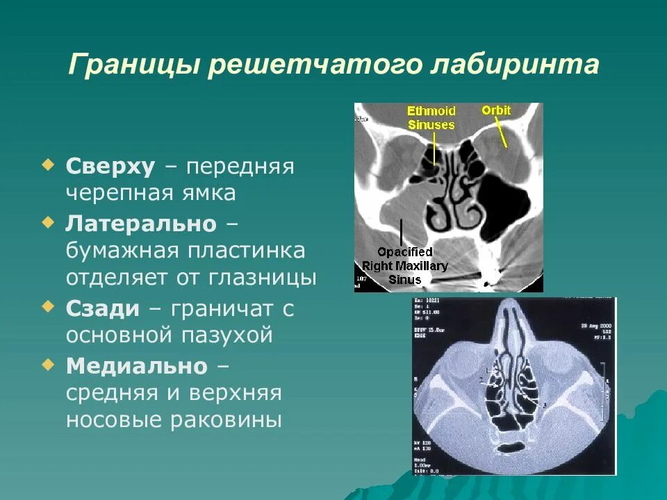 Клетки решетчатого Лабиринта. Строение решетчатого Лабиринта. Решетчатый Лабиринт анатомия. Утолщение слизистой оболочки решетчатых лабиринтов