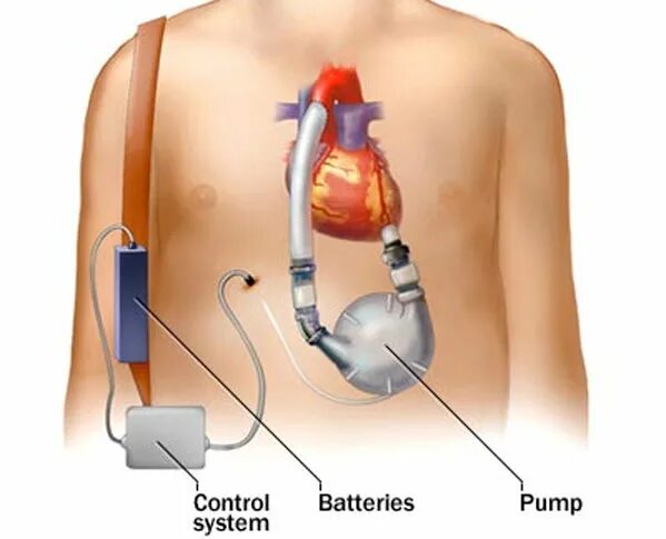 Искусственный желудочек сердца. Насос для искусственного сердца. Искусственный левый желудочек сердца.