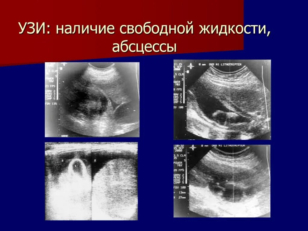 Свободная жидкость в дугласовом пространстве что это. Свободная жидкость в дугласовом пространстве что это
