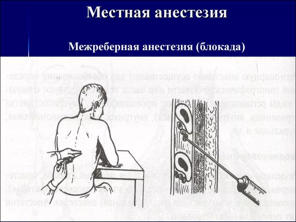 Межреберная блокада. Обезболивание местной анестезии. Местная анестезия презентация. Местная анестезия блокады.