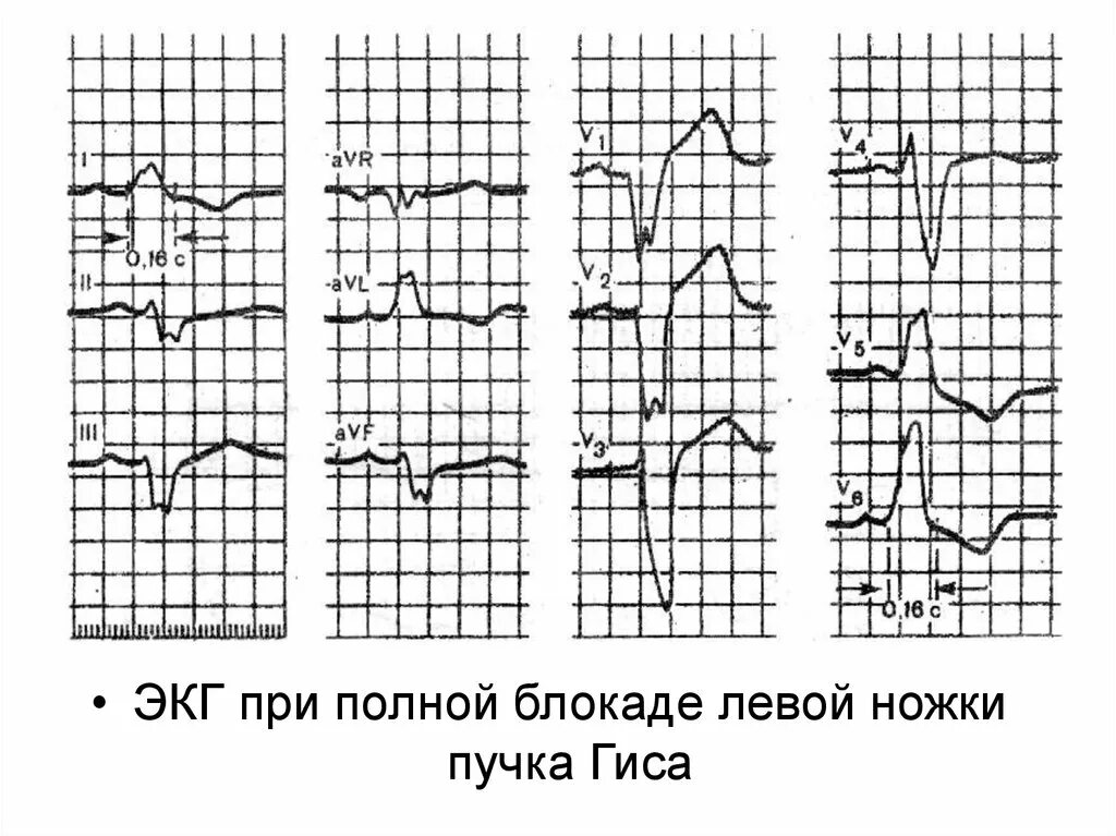 Блокада левого и правого пучка гиса. Блокада левой ножки пучка Гиса на ЭКГ. Блокада ножки пучка Гиса на ЭКГ. ЭКГ критерии блокады левой ножки пучка Гиса. Блокада правой ножки пучка Гиса на ЭКГ.