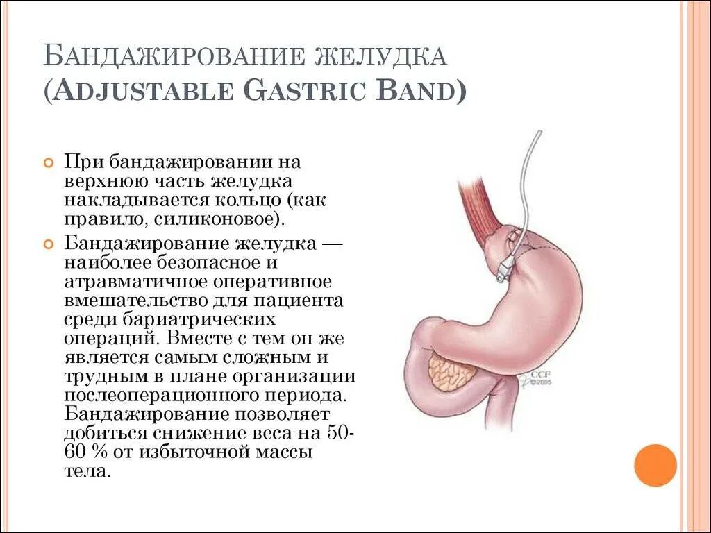 После удаления части желудка. Лапароскопическое регулируемое бандажирование желудка. Желудочный шунтирование желудка. Бариатрическая операция бандажирование желудка. Регулируемое кольцо желудка.