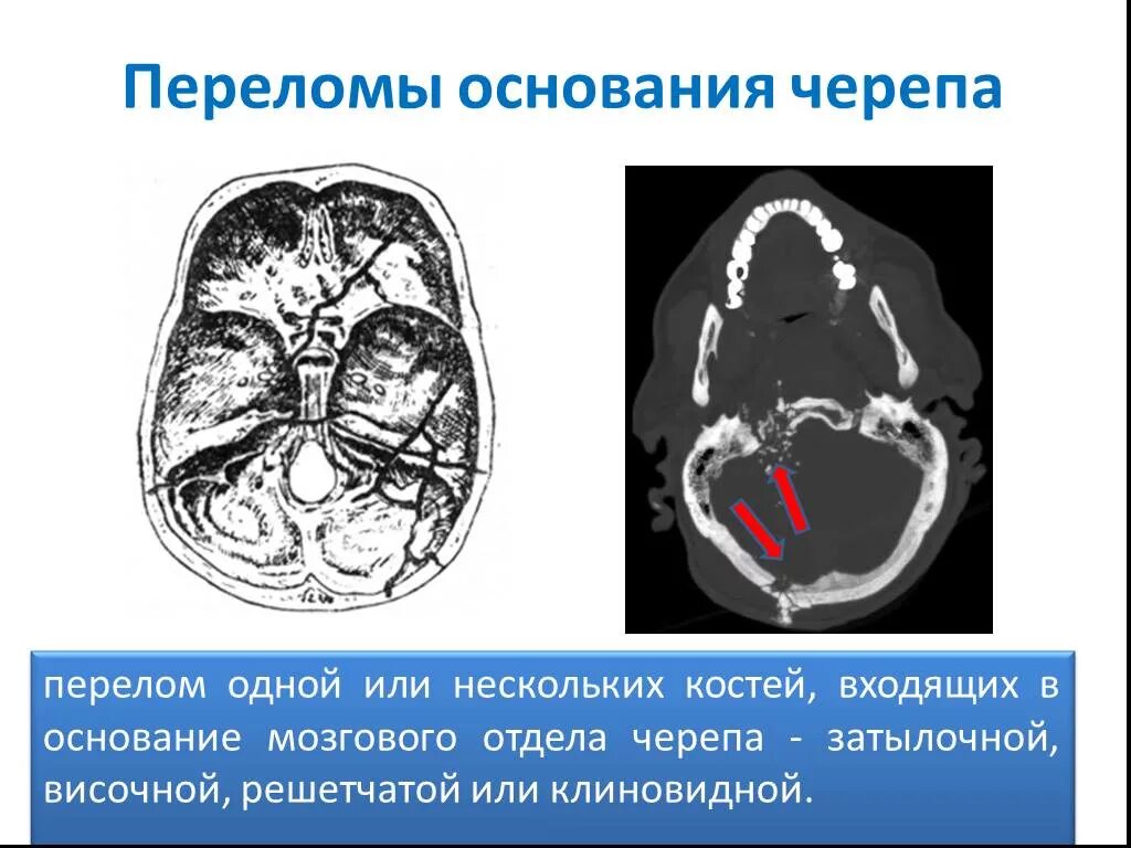 Для перелома основания черепа характерно. Кольцевидный перелом основания черепа. Перелом костей основания черепа. Перелом основания Черпер. Перелом основания черепа на кт.