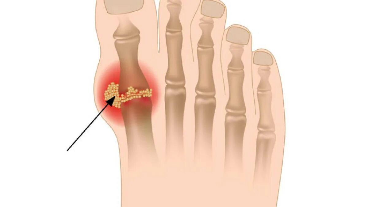 Ногтевая фаланга стопы. Подагра большого пальца ноги.
