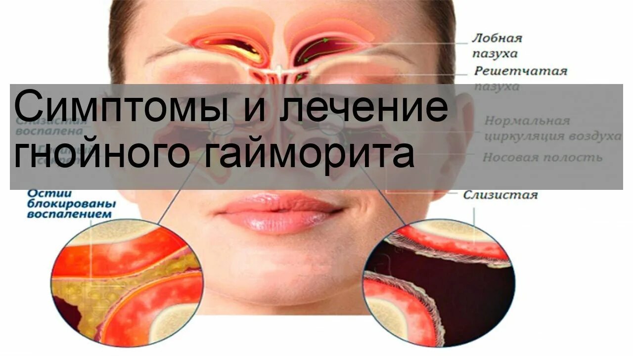 Как заболеть гайморитом