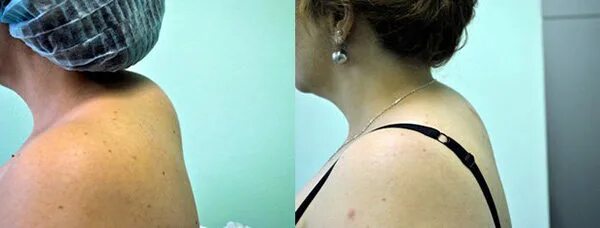 Вдовий горбик холка липома. Солевой горб. Липосакция вдовьего горба холки. Вдовий горбик холка 7 шейный позвонок. Отложение солей вдовий горб.