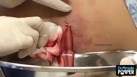 Inflamed Cyst Waterfall on the Back with Dr Pimple Popper.