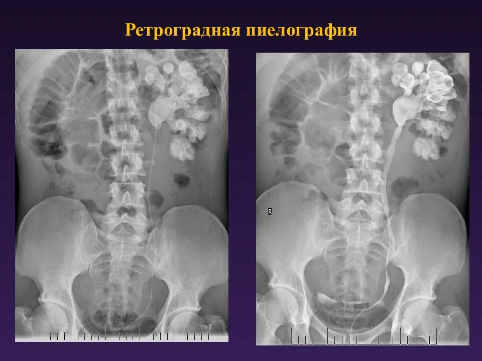 Рентген мочеточника. Экскреторная пиелография. Ретроградная пиелография. Антероградна яурография рентген. Экскреторная урография уретерогидронефроз.