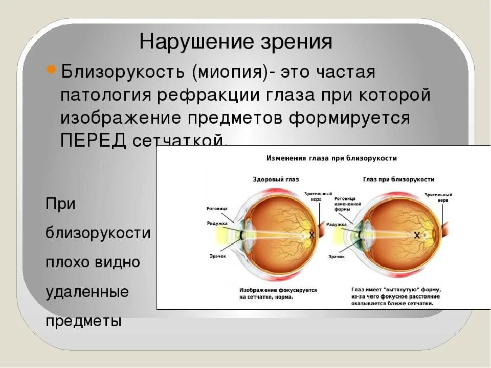 Миопия что это такое у детей. Близорукость (истинная и ложная формы патологии). Аномалии рефракции глаза близорукость дальнозоркость астигматизм. Миопия глазное яблоко. Структуры глаза при миопии.