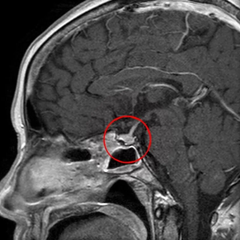 Аденома гипофиз мозга что это такое. Мрт микроаденома гипофиза мрт. Аденома гипофиза снимок мрт. Мрт головы аденома гипофиза. Пролактинома гипофиза мрт.