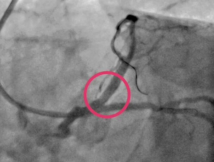 Коронарное стентирование. Коронарография баллонная ангиопластика. Стентирование коронарных артерий. Стентирование коронарных сосудов. Стентирование сосудов последствия