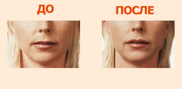 Поднятие уголков губ до и после Форма губ после гиалуроновой кислоты фото (большое количество изображений) art