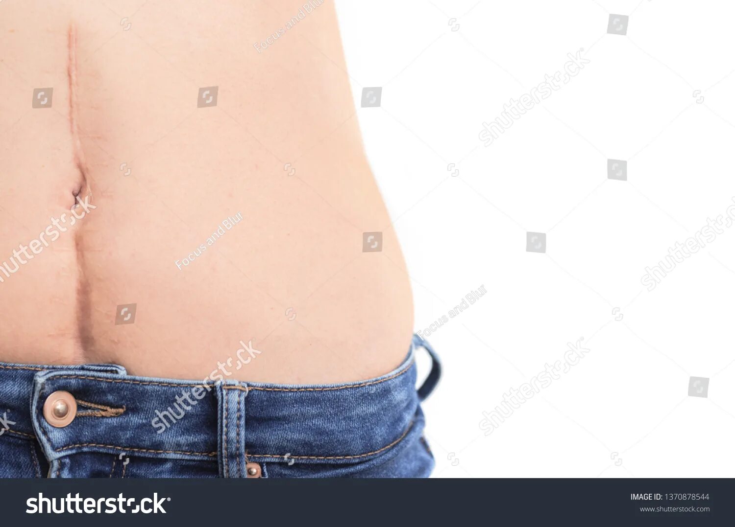 Вдоль живота. Шрам после кесарева сечения оксаны. Женский пупок живота. Вдоль живота. Миниабдоминопластика живота схема.